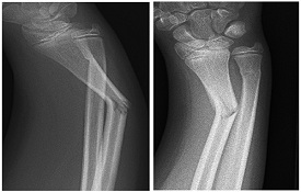 greenstick fracture